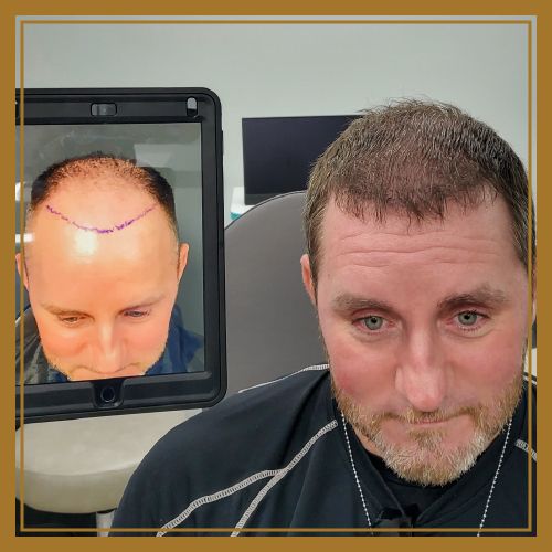 hair loss restoration before and after image