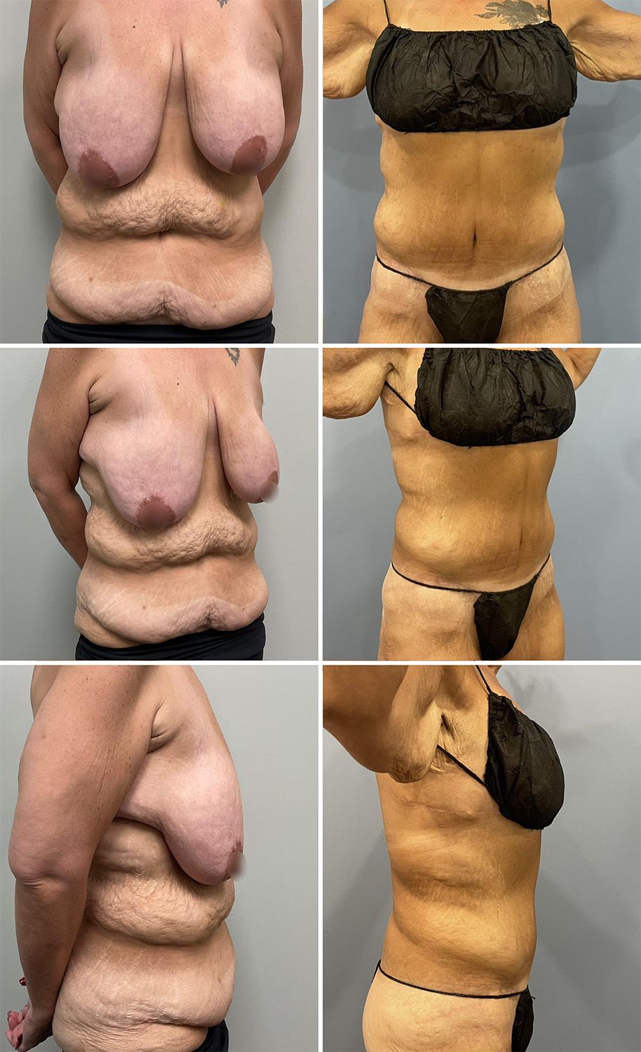 Tummy Tuck Performed by Dr. Bonett