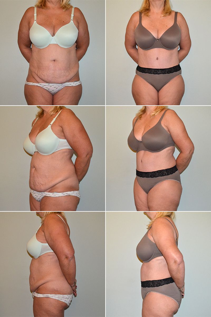tummy tuck 12