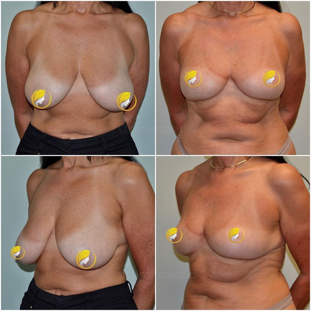 Breast Reduction and Lift by Dr. Baccaro