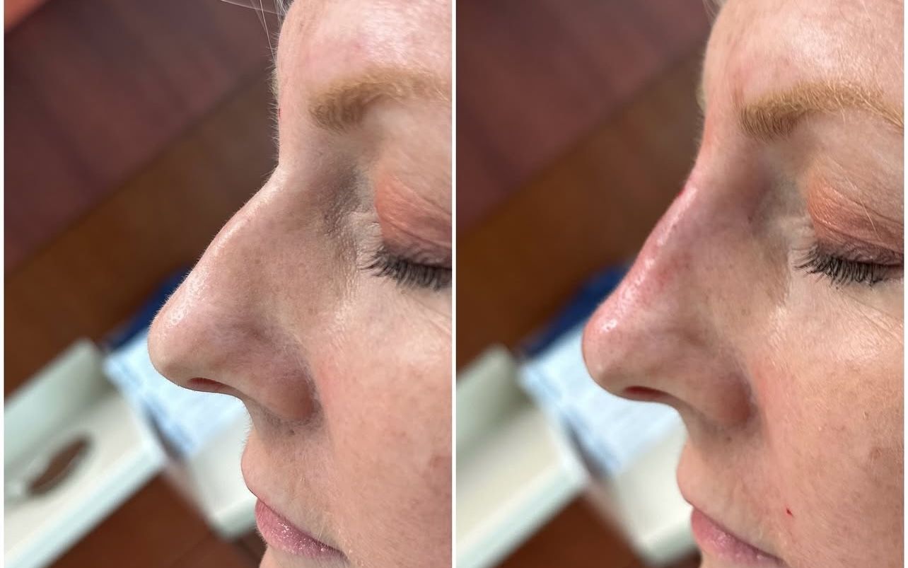 Liquid Rhinoplasty by Dr. Baccaro