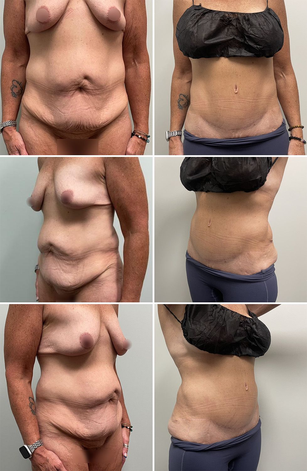 Panniculectomy Performed by Dr. Bonett