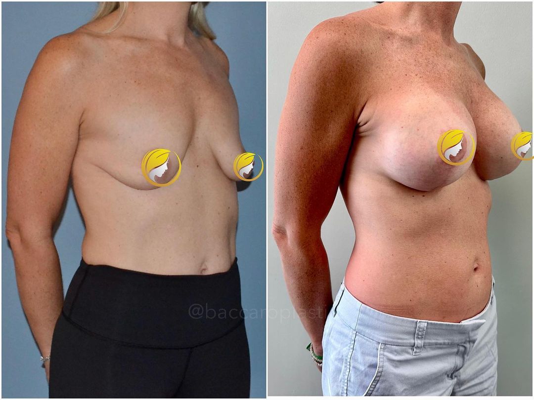 Breast Augmentation with Fat Transfer by Dr. Baccaro