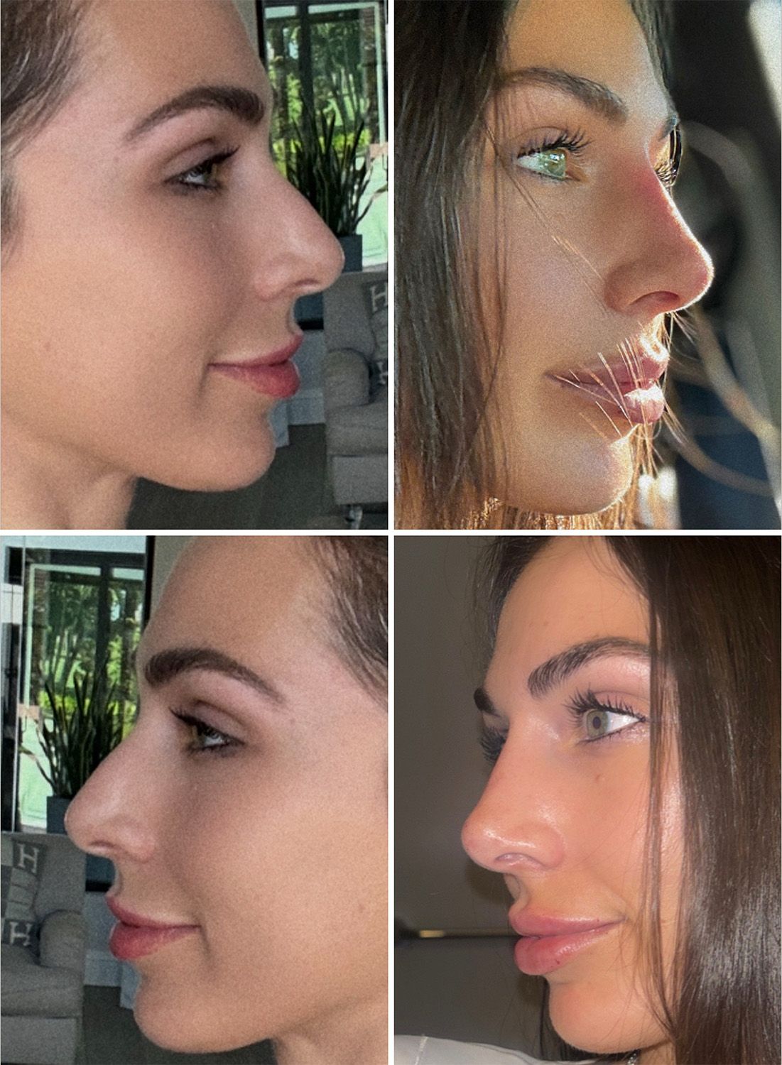 Liquid Rhinoplasty Performed by Dr. Baccaro