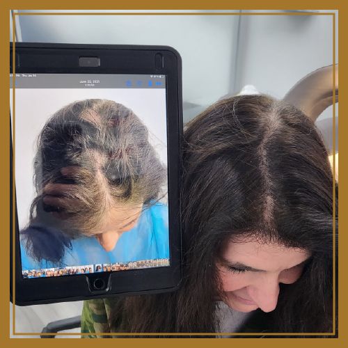 Female naples hair restoration patient