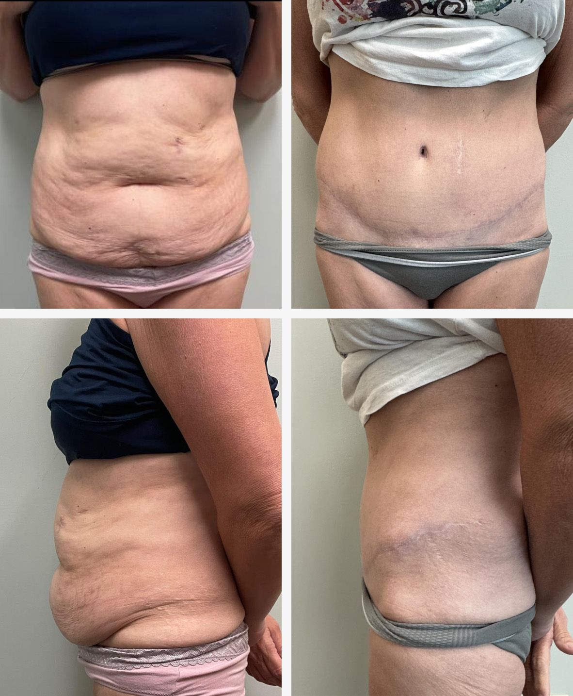 Panniculectomy Surgery Performed by Dr. Bonett