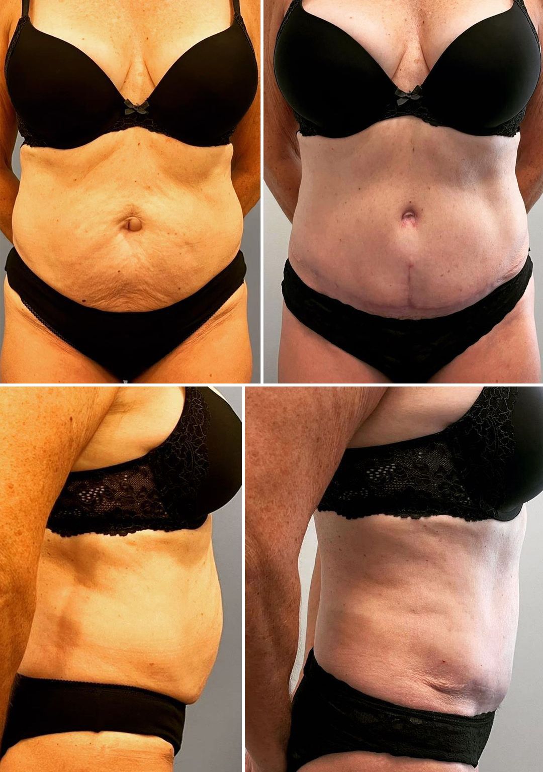 Abdominoplasty by Dr. Andrew Bonett