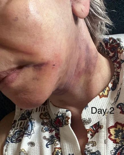 Neck Lift & Facial Fat Transfer Day 2