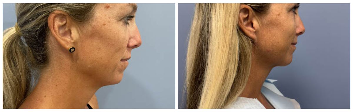 Dr Walsh Neck Liposuction with Skin Tightening Patient 1