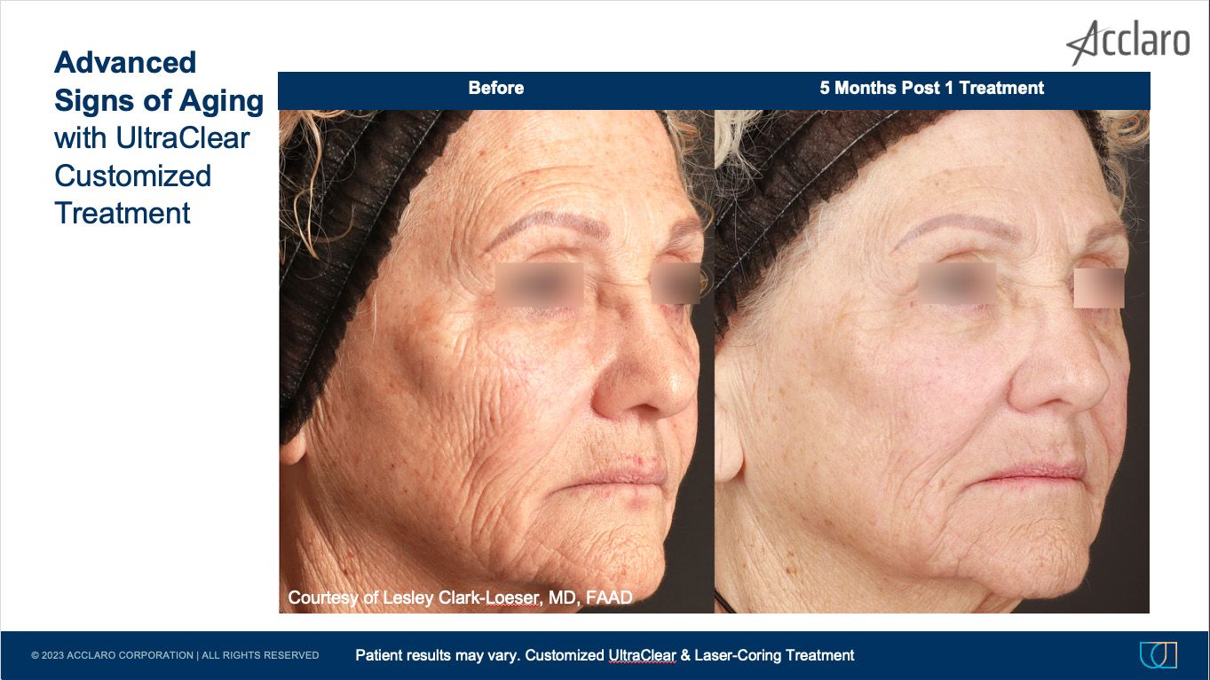 UltraClear Laser Performed by Lesley Clark-Loeser