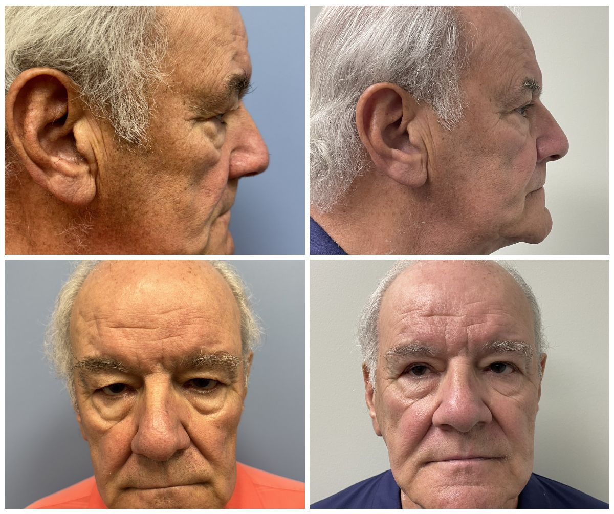 Dr. Andrew Bonett – Upper Blepharoplasty Patient