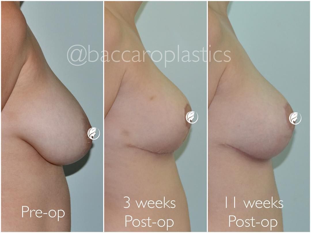 Breast Lift and Reduction by Dr. Baccaro