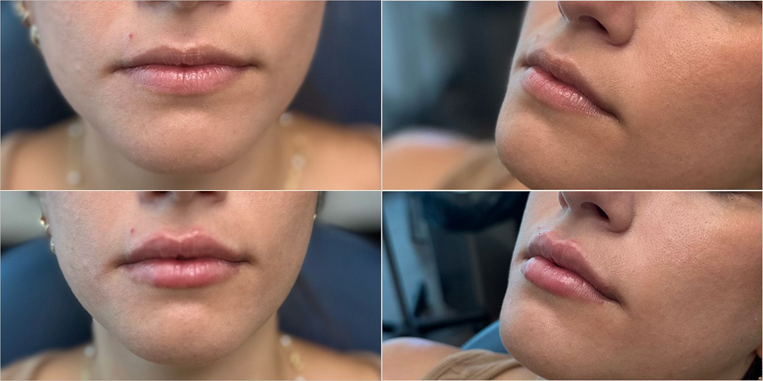 Lip Filler by Dr. Baccaro
