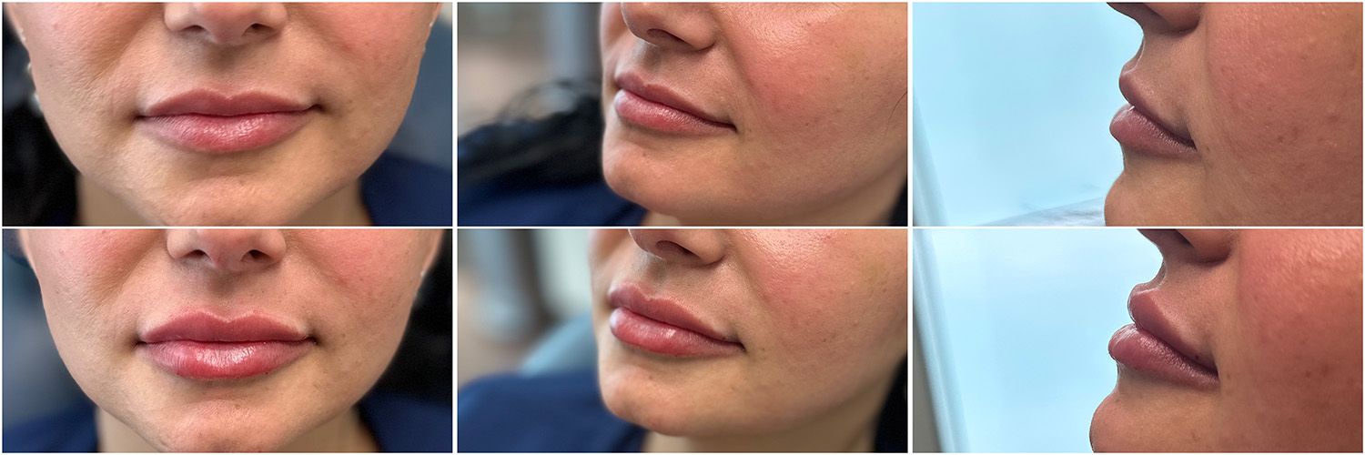 Lip Filler Performed by Dr. Baccaro