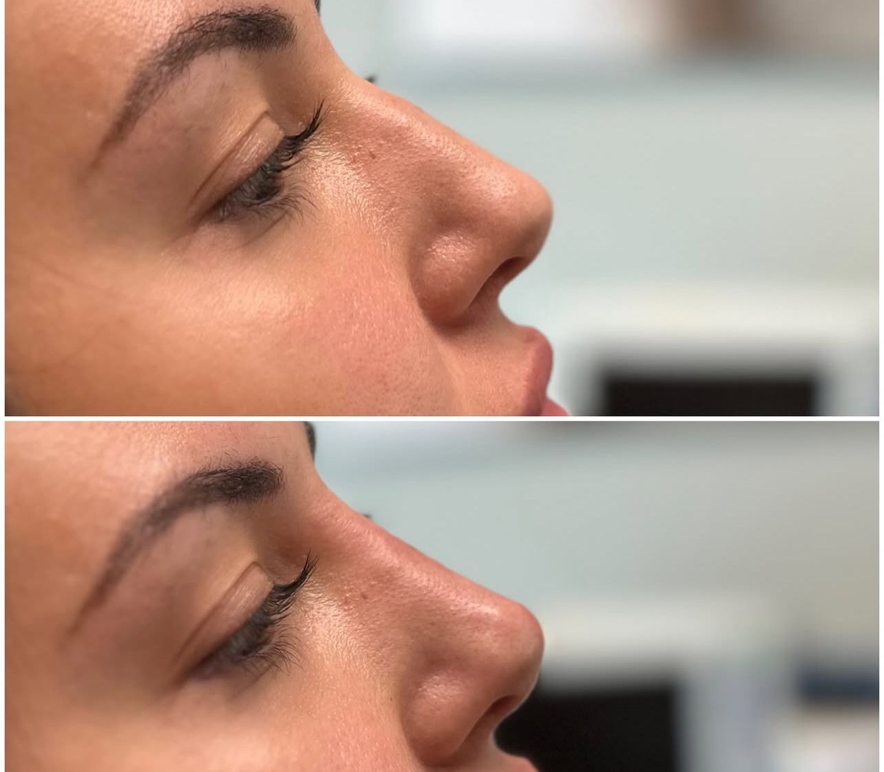 Liquid Rhinoplasty by Dr. Baccaro