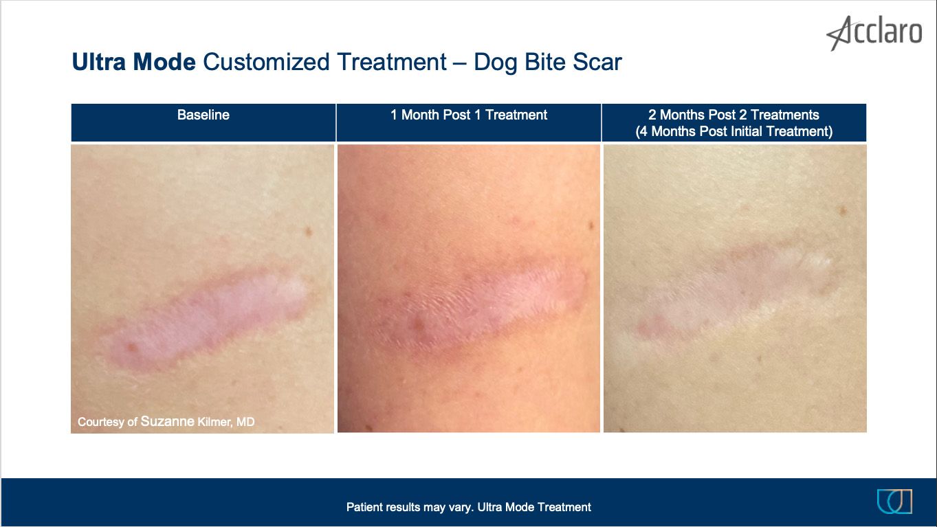 UltraClear Laser Performed by Suzanne Kilmer