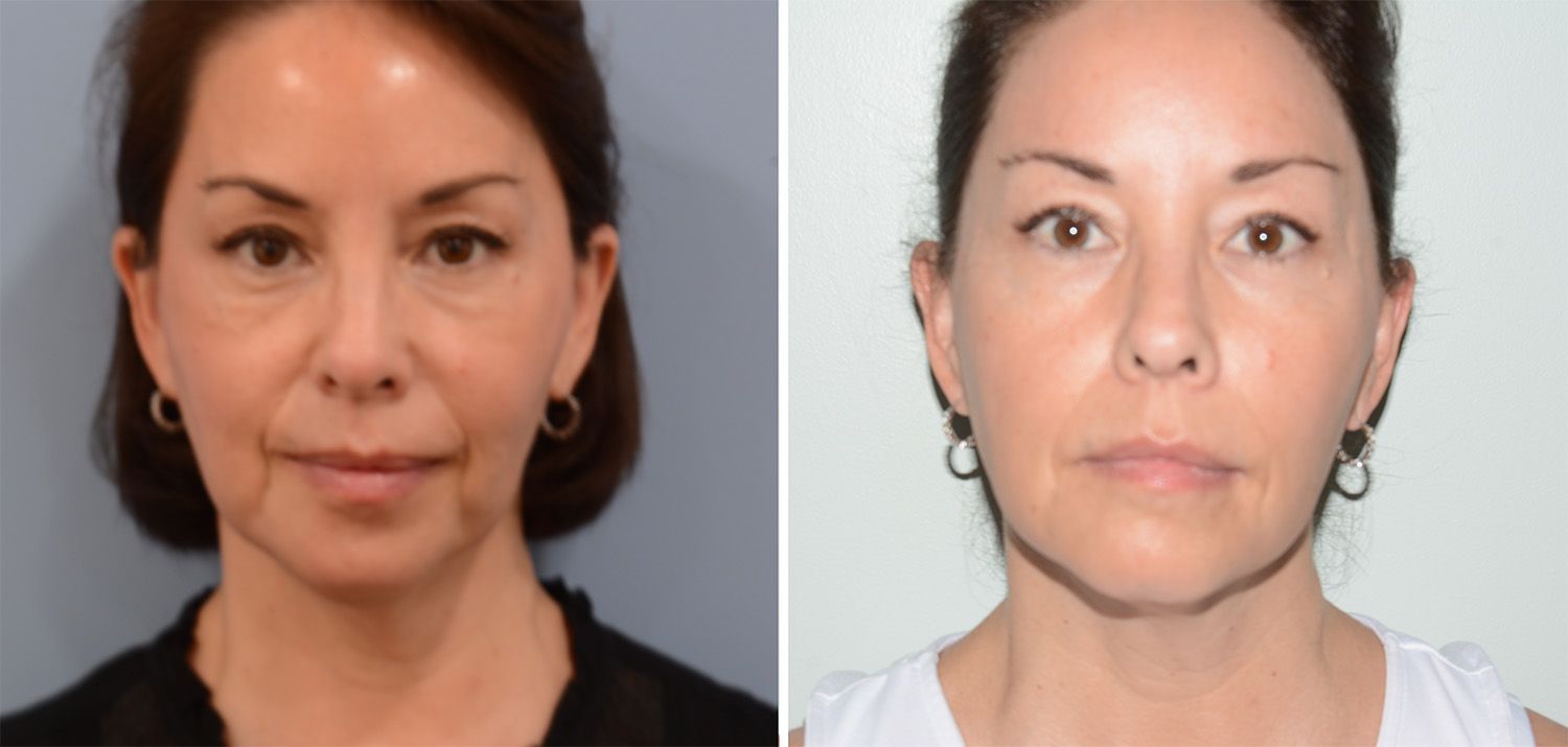 Fat Grafts to Face Performed by Dr. Gardner