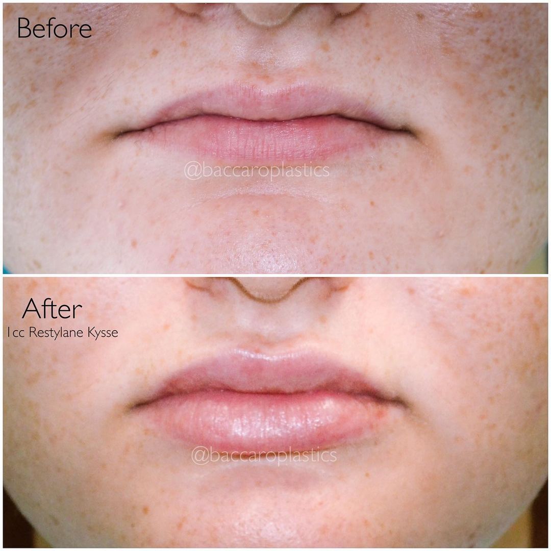 Lip Augmentation by Dr. Baccaro