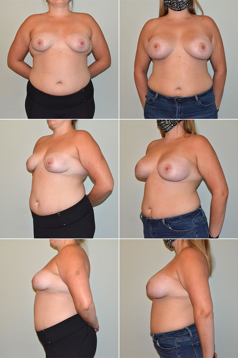 Hybrid Breast Augmentation Performed by Dr. Baccaro