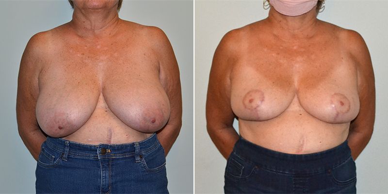 baccaro breast reduction 3