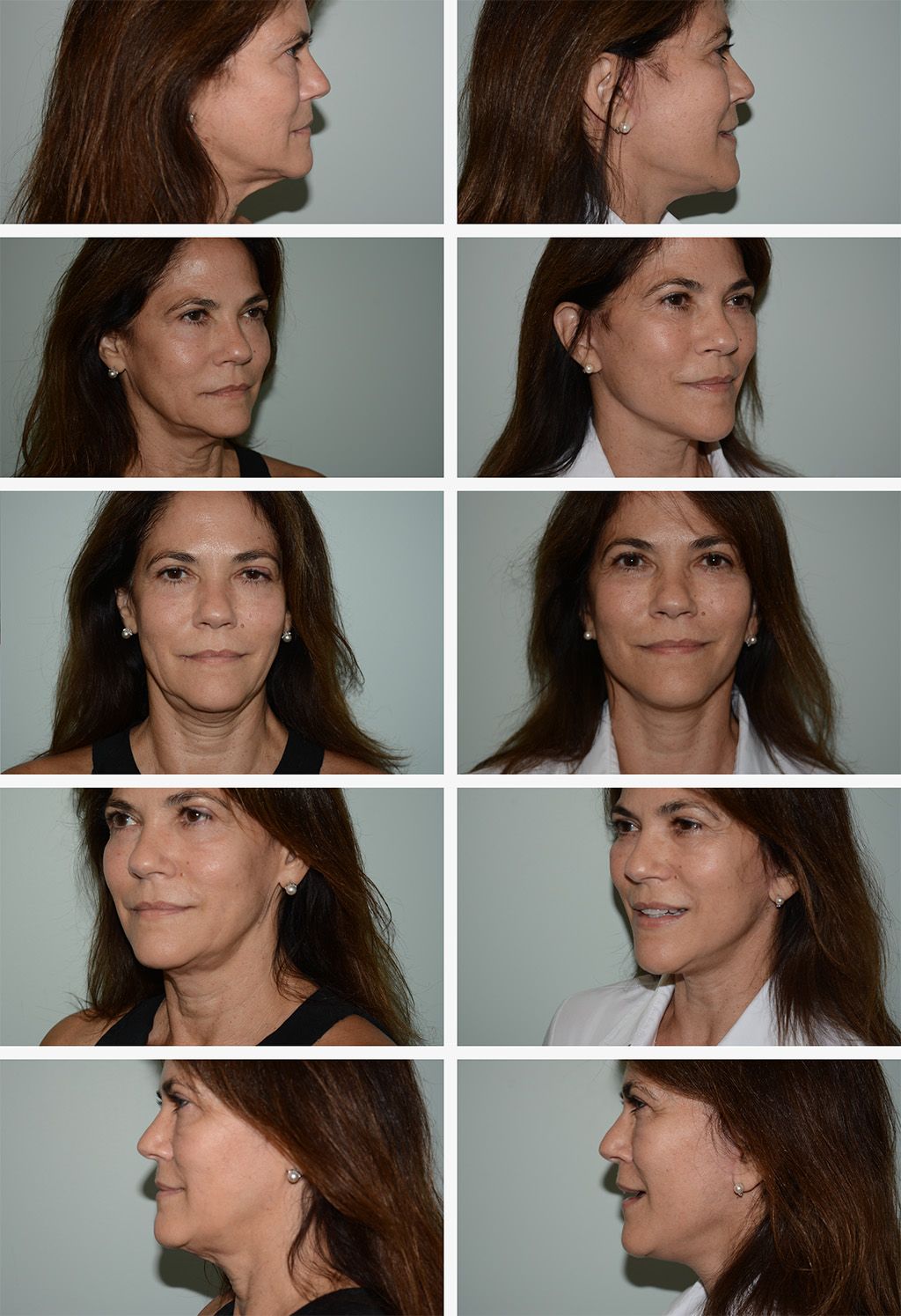 Mini Facelift Performed by Dr. Gardner