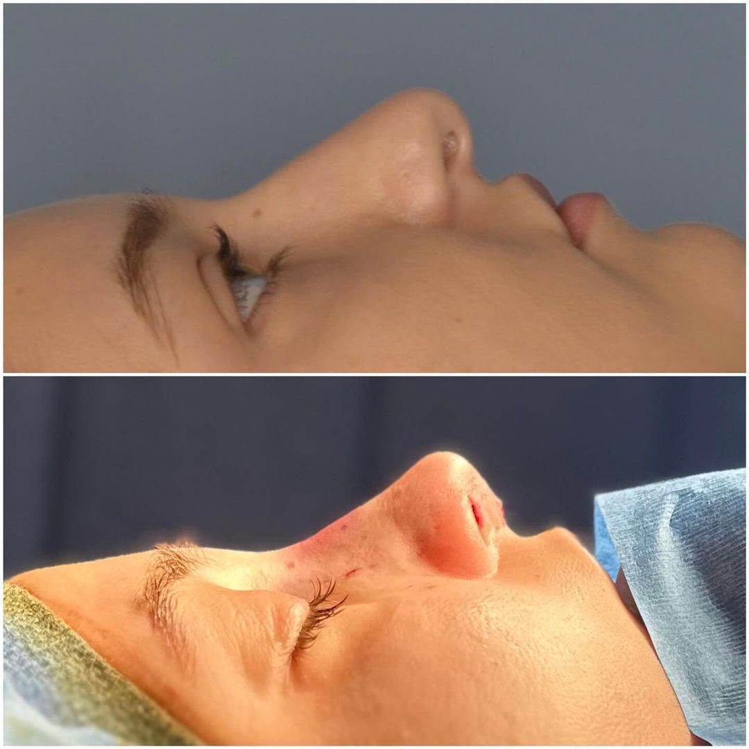 Rhinoplasty by Dr. Baccaro