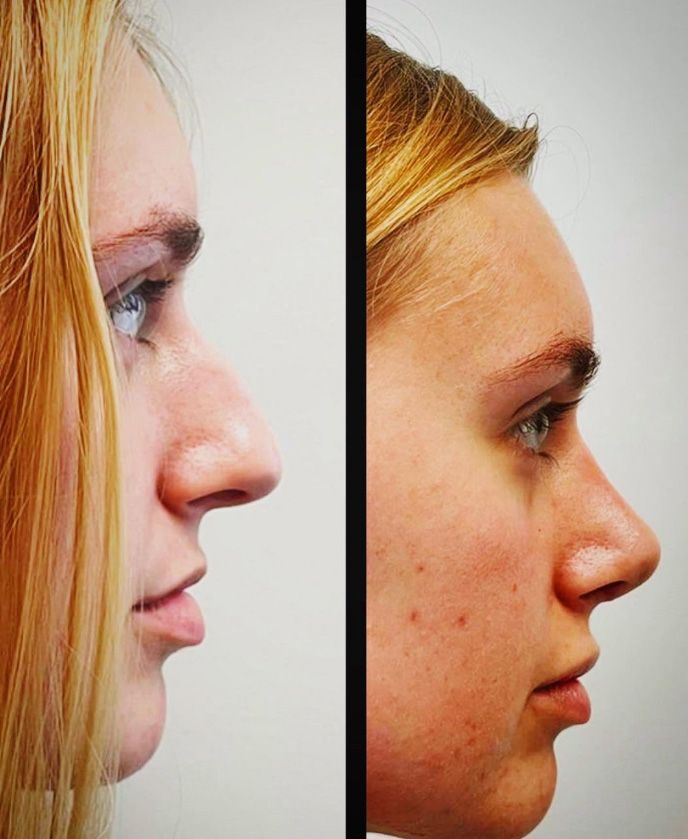 bonett rhinoplasty 1