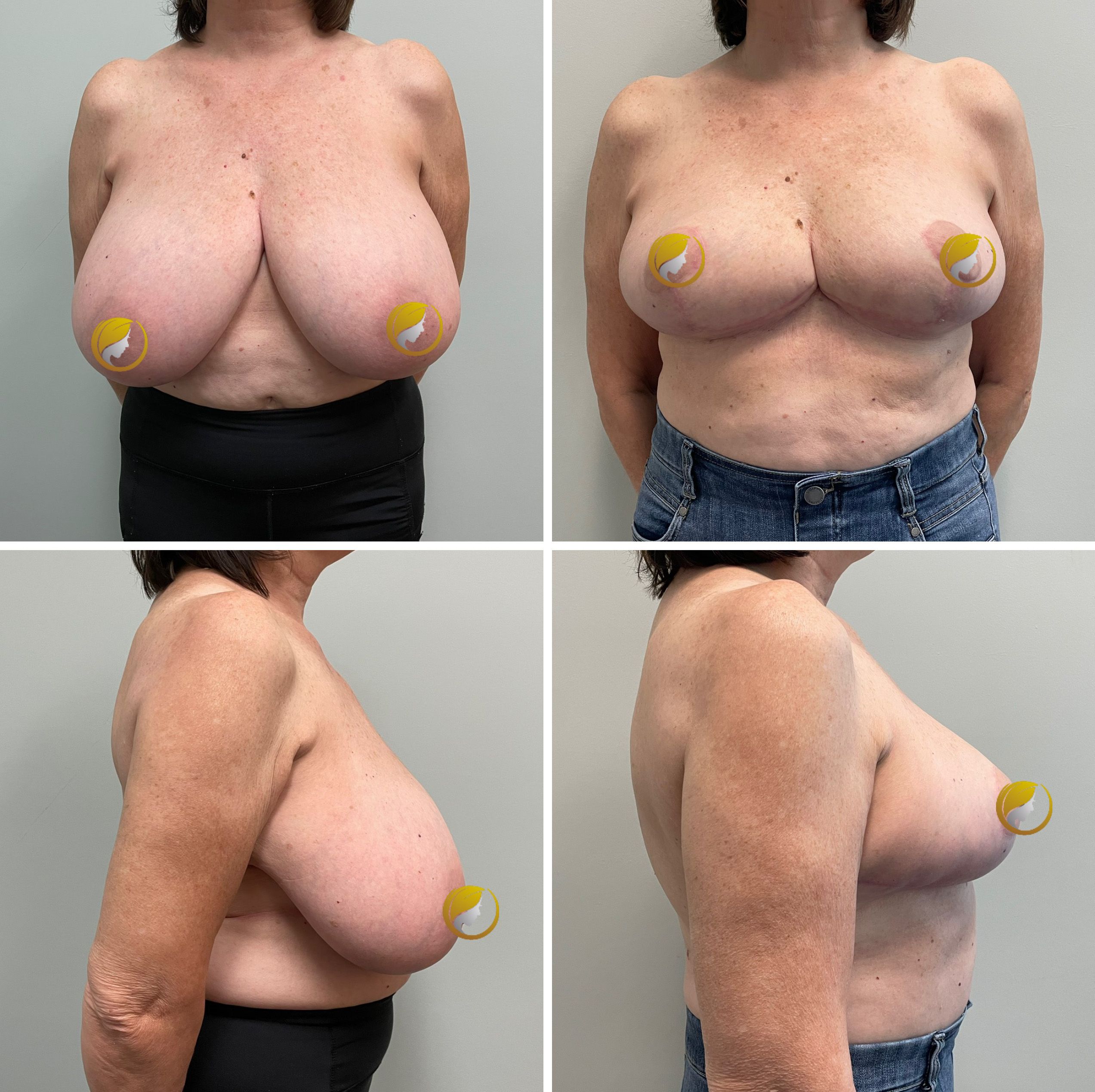 Surgery Performed by Dr. Andrew Bonett