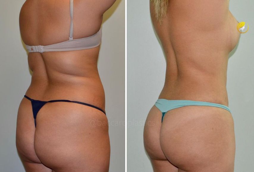 Liposuction by Dr. Leo Baccaro