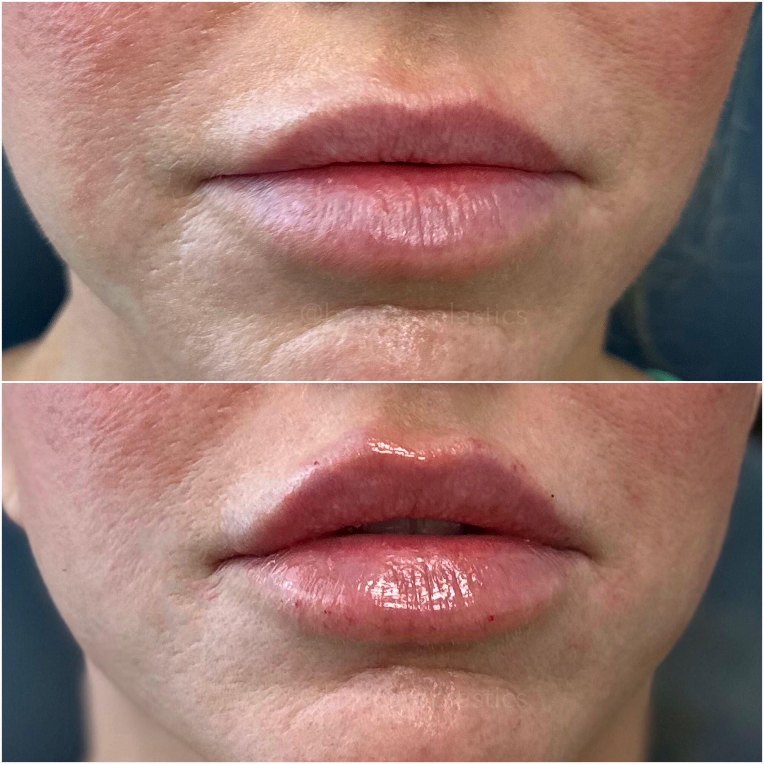 Lip Filler by Dr. Baccaro