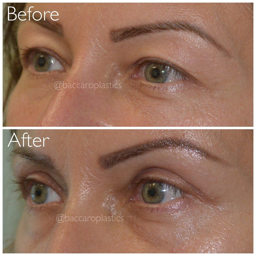 Upper Blepharoplasty by Dr. Baccaro