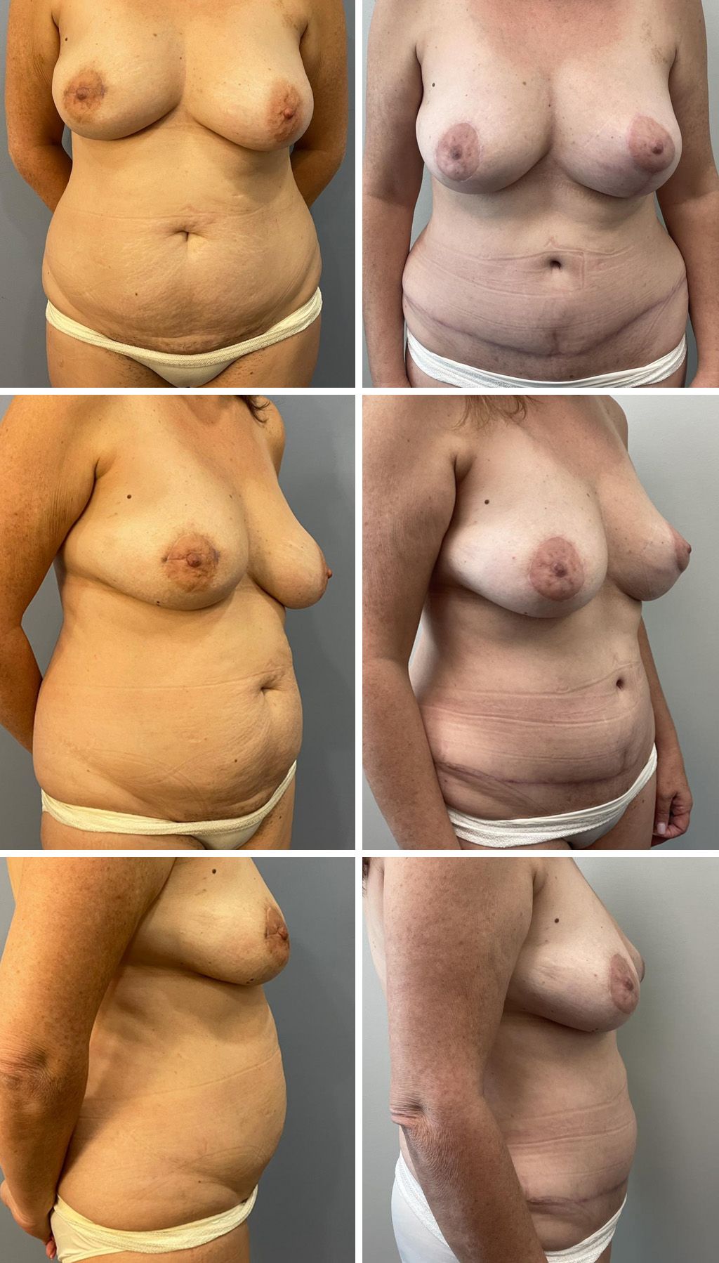 Tummy Tuck Performed by Dr. Bonett