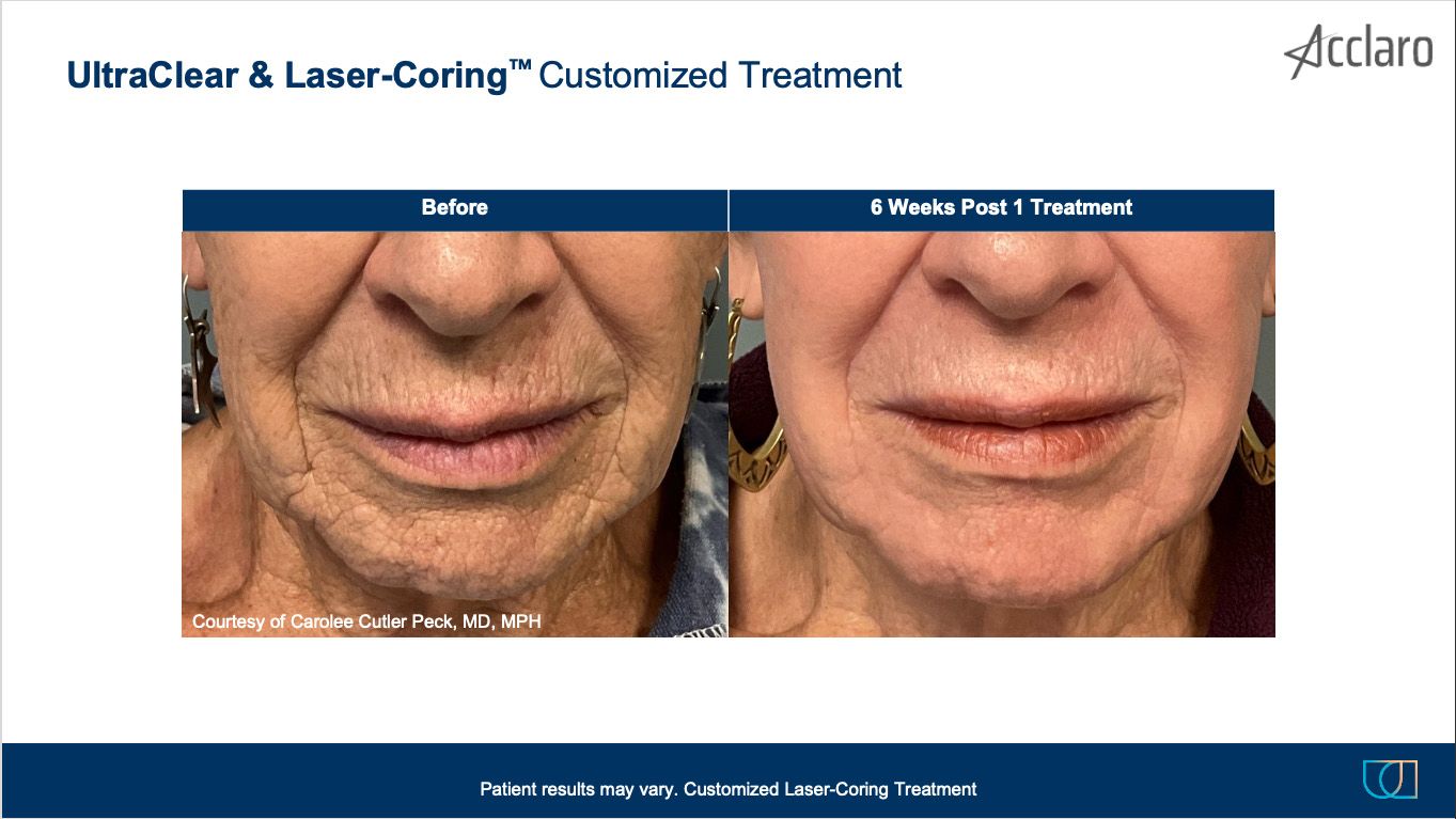 UltraClear Laser Performed by Carolee Cutler Peck