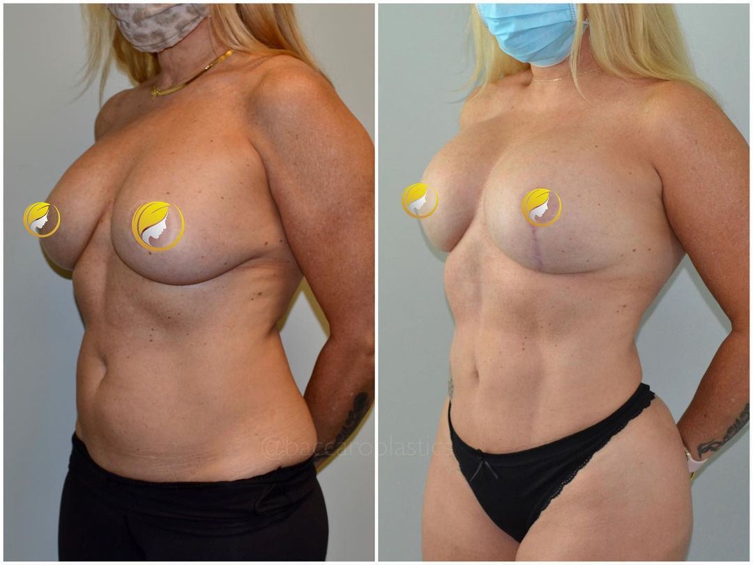 Implant Exchange + Hi-Def Lipo by Dr. Baccaro