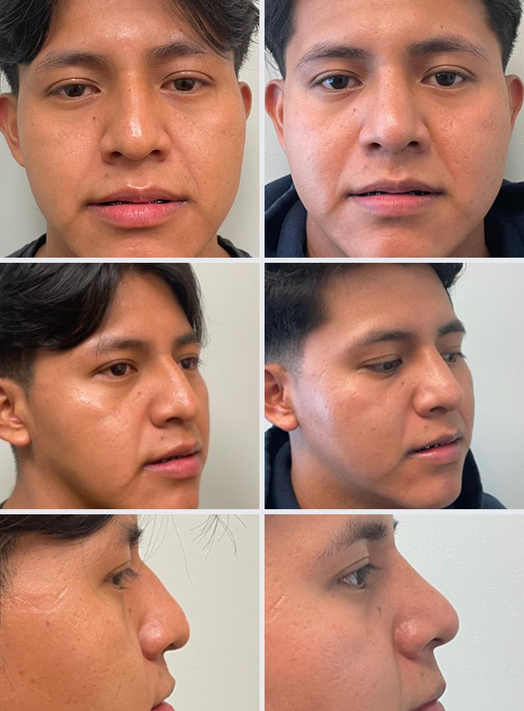 Rhinoplasty Performed by Dr. Bonett