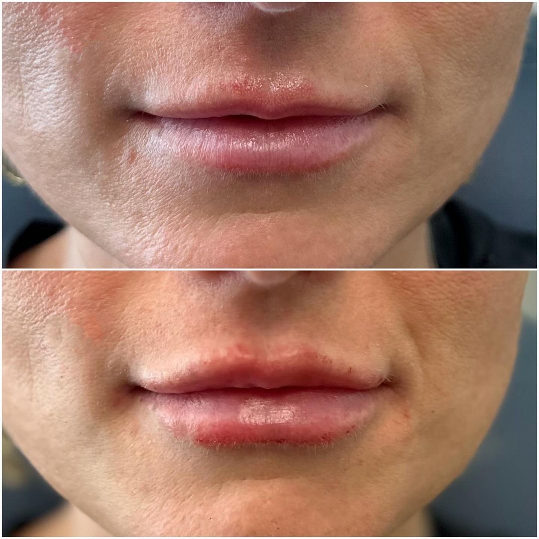 Lip Augmentation by Dr. Baccaro
