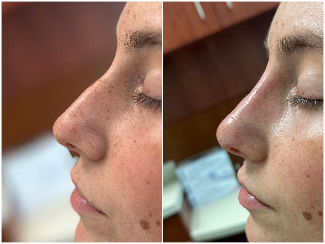 Rhinoplasty by Dr. Baccaro