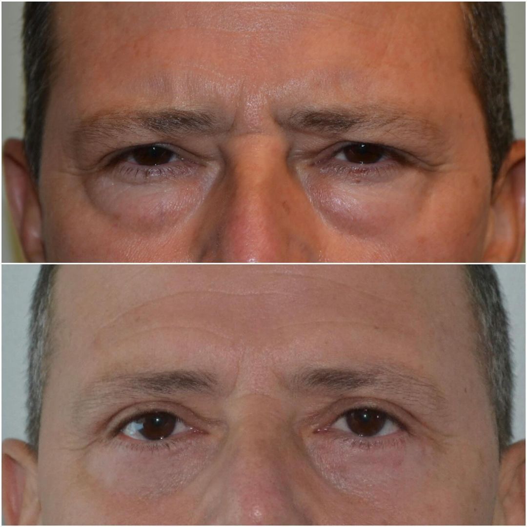 Upper and Lower Blepharoplasty by Dr. Baccaro