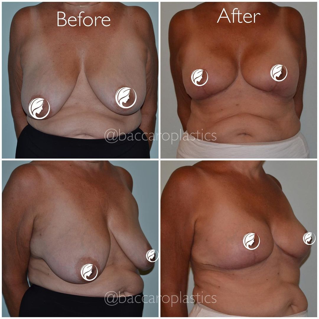 Breast Reduction and Lift by Dr. Baccaro