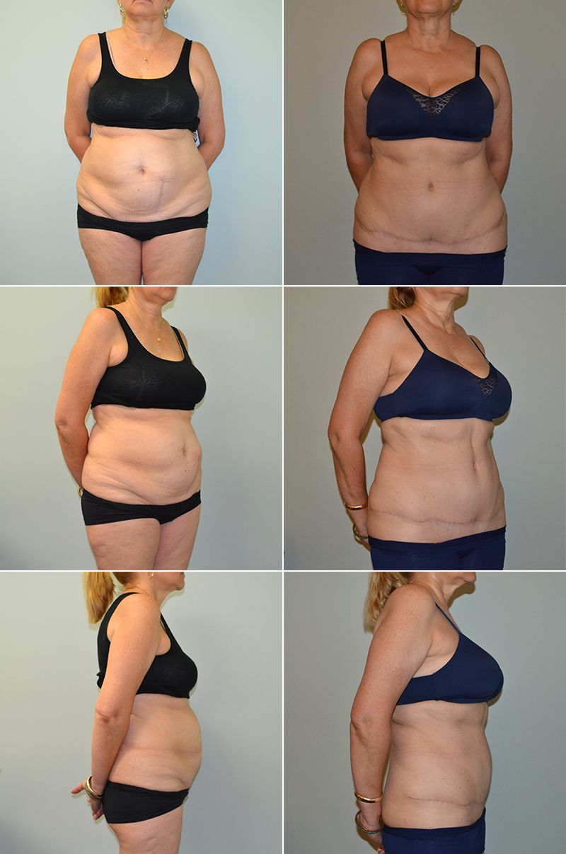 tummy tuck 12