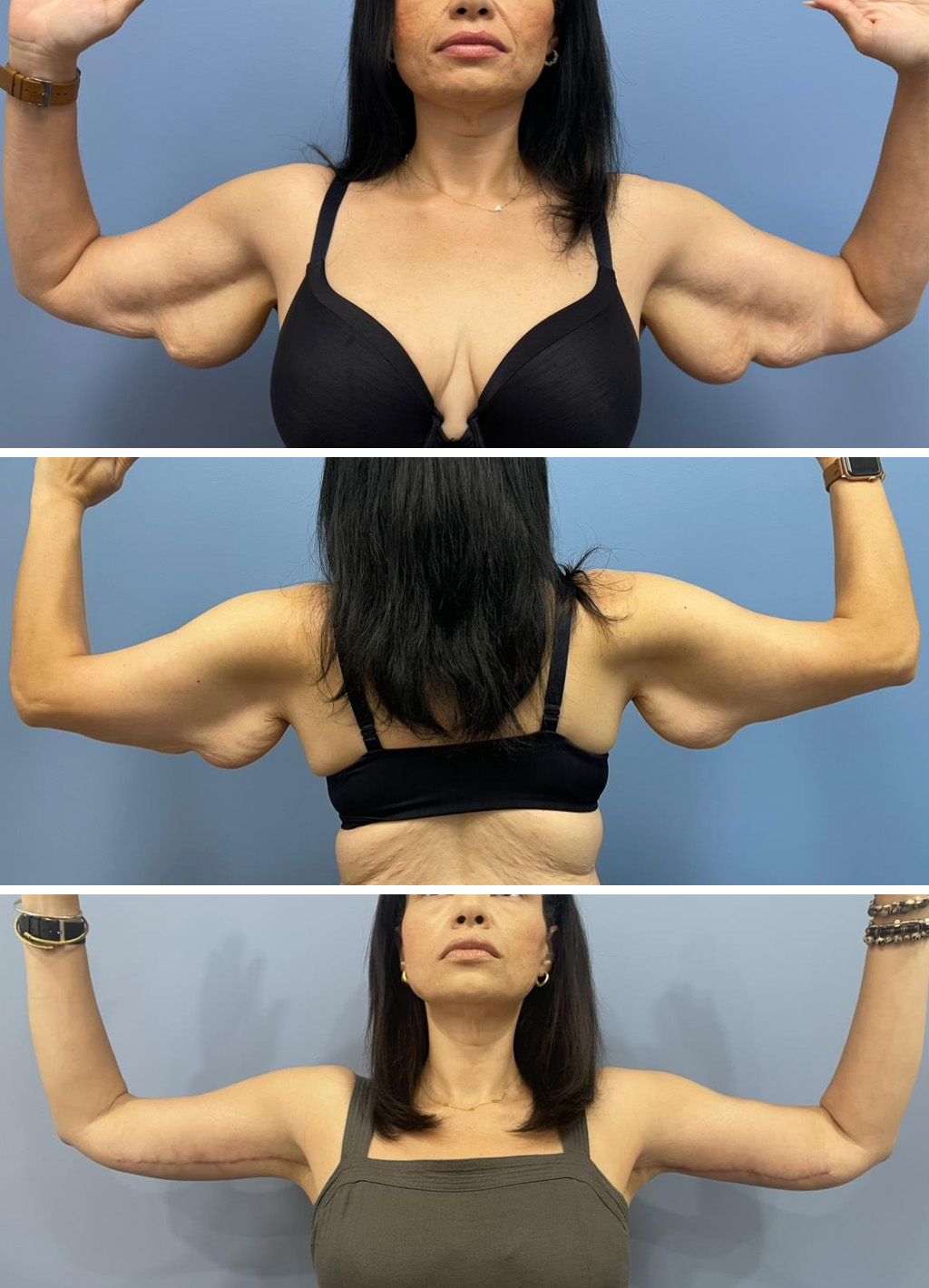 Arm Lift Performed by Dr. Bonett