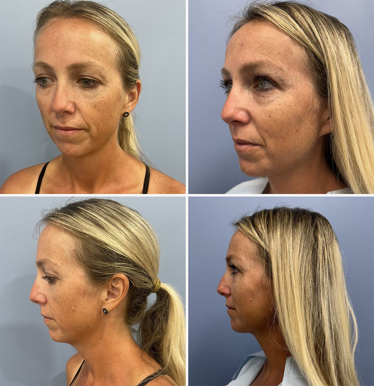 Fat Grafts to Chin Performed by Dr. Walsh