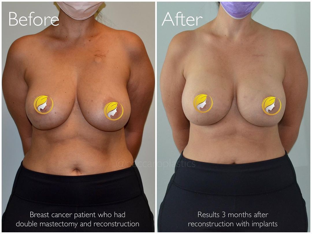 Breast Reconstruction by Dr. Baccaro