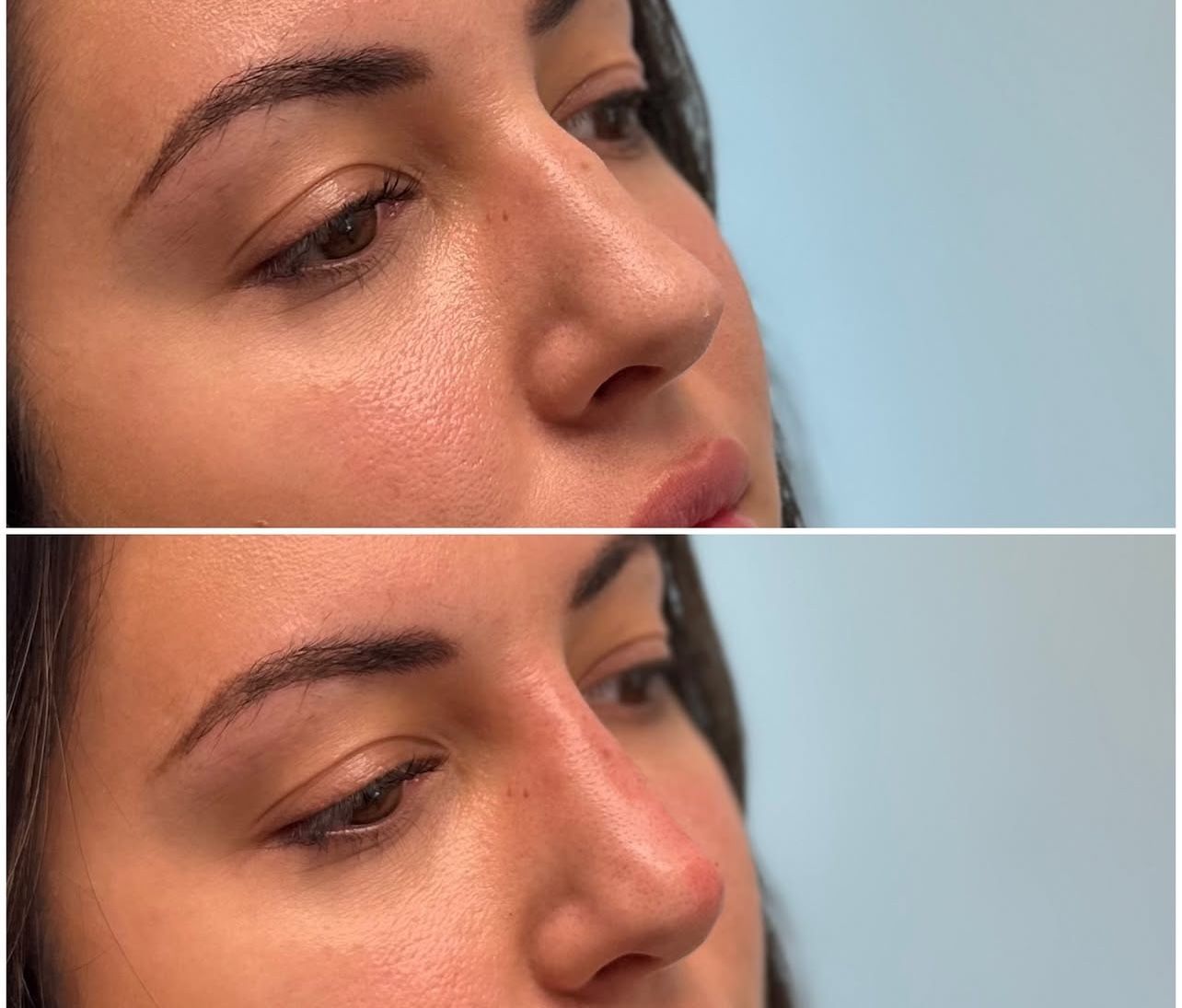 Liquid Rhinoplasty by Dr. Baccaro