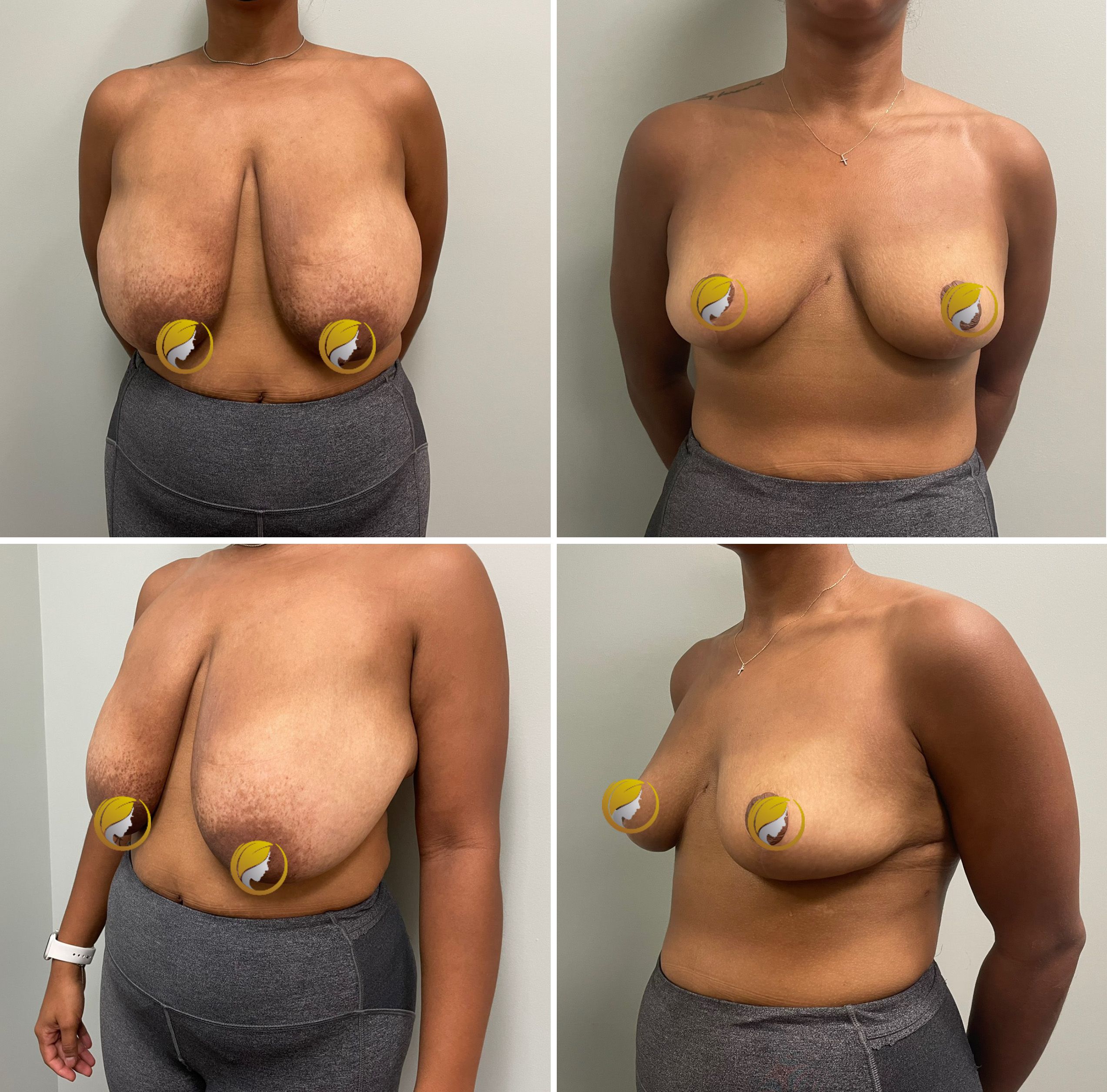 Surgery Performed by Dr. Andrew Bonett