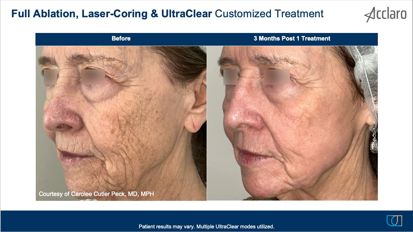 UltraClear Laser Performed by Carolee Cutler Peck