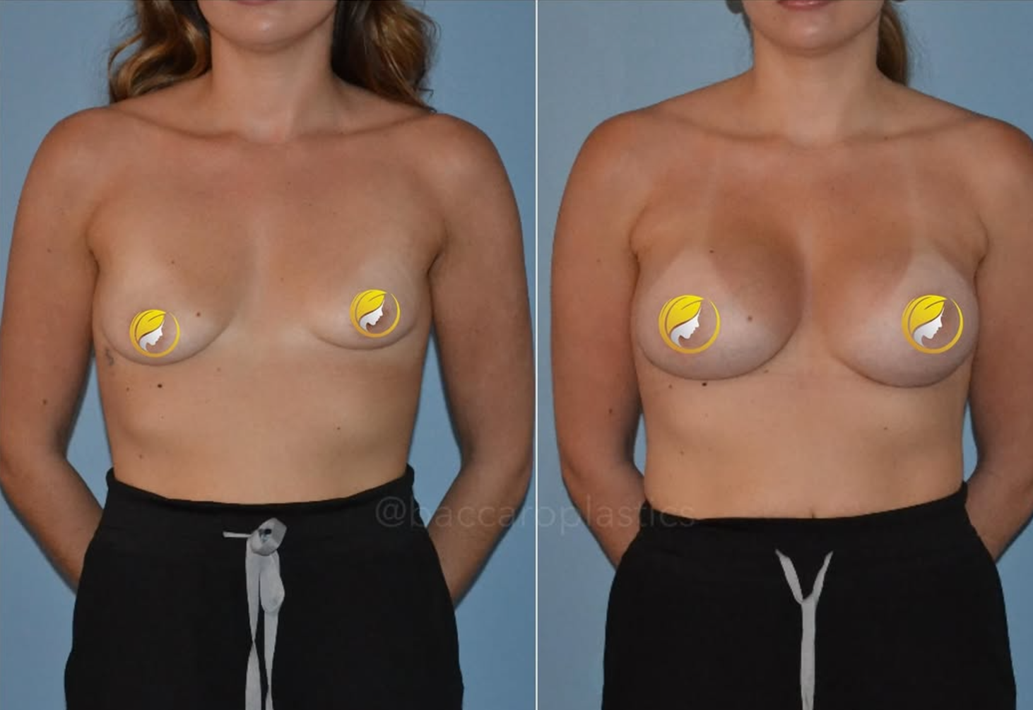 Hybrid Breast Augmentation Performed by Dr. Baccaro