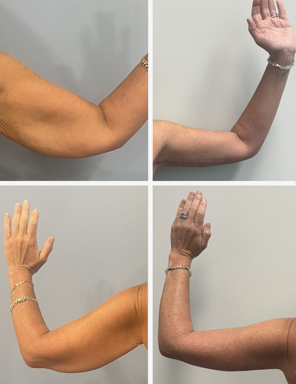 Arm Lift Performed by Dr. Walsh