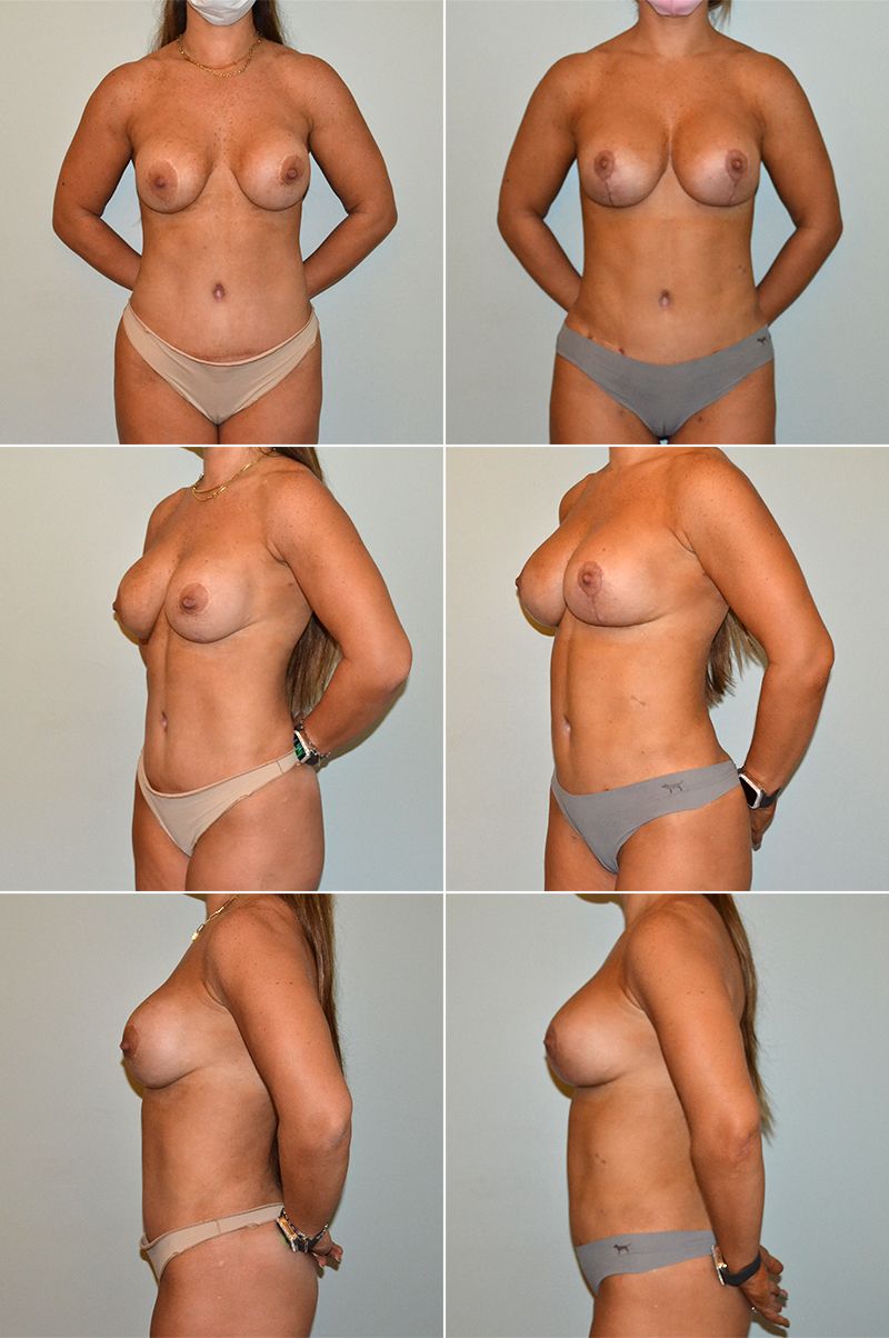 Dr. Baccaro breast implant revision before and after image