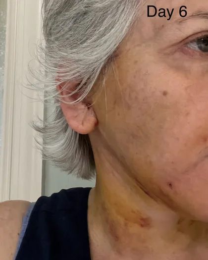 Neck Lift & Facial Fat Transfer Day 6